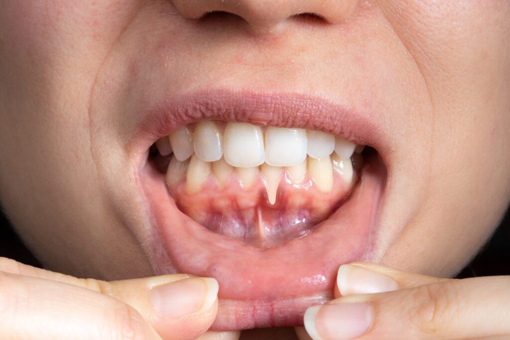 Preparing for teeth whitening with receding gums Marlow